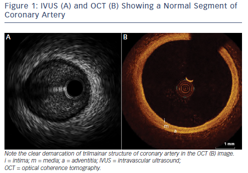 Coronary Imaging For Percutaneous Coronary Intervention PCI