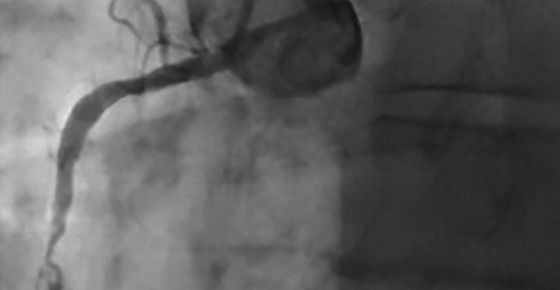 Coronary Intervention with the Excimer Laser: Review of the Technology and Outcome Data