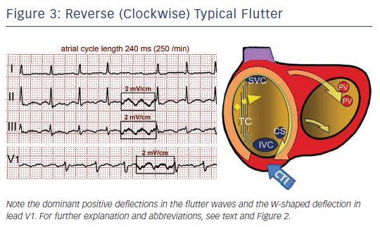 Figure 3 Reverse Clockwise Typical Flutter Radcliffe Vascular