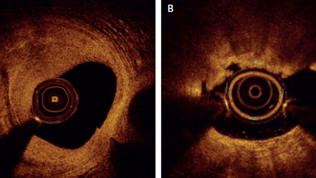 Calcified Lesion Assessment and Intervention in Complex Percutaneous Coronary Intervention: Overview of Angioplasty, Atherectomy, and Lithotripsy