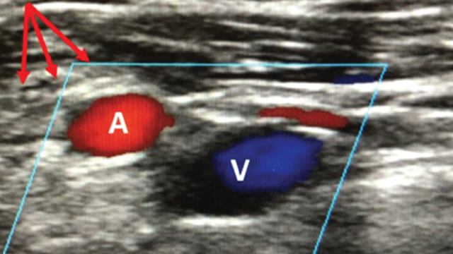 Emerging Role of Large-bore Percutaneous Axillary Vascular Access: A Step-by-step Guide