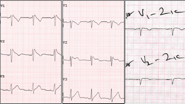 Current Controversies and Challenges in Brugada Syndrome