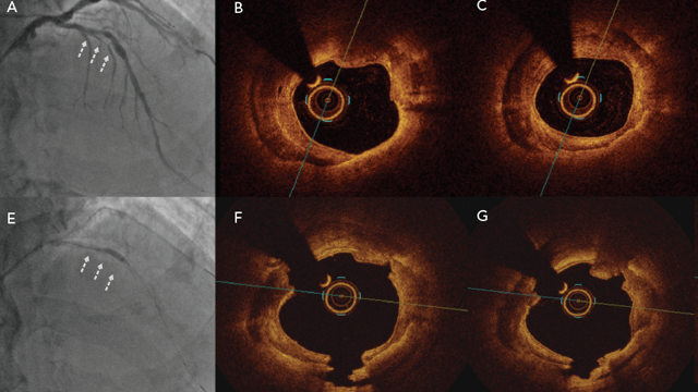 Contemporary Approach to Heavily Calcified Coronary Lesions
