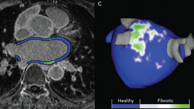 Cardiac MRI to Manage Atrial Fibrillation
