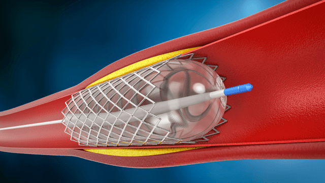A Review of Available Angioplasty Guiding Catheters, Wires and Balloons