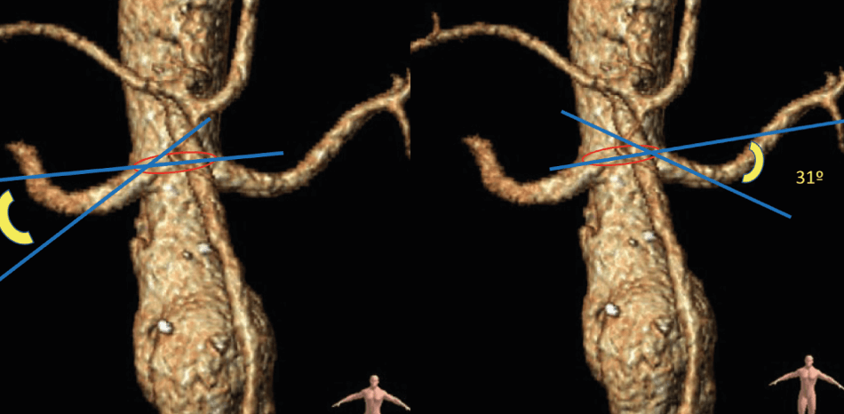 Endovascular Rescue of Simultaneous Renal Stent Thrombosis: Case Report