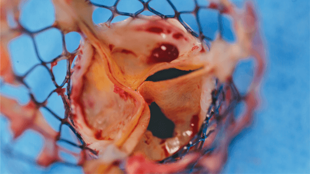 Differences in Outcomes and Indications between Sapien and CoreValve Transcatheter Aortic Valve Implantation Prostheses