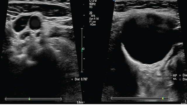 Ultrasound Detection of Extracranial Carotid Aneurysms