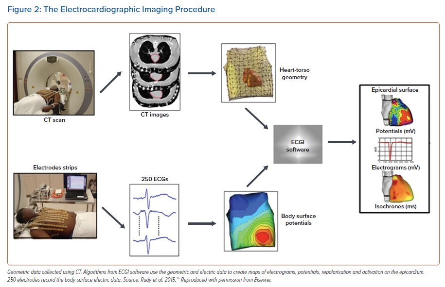 Use Of ECGI For Catheter Ablation Of Ventricular Tachycardia