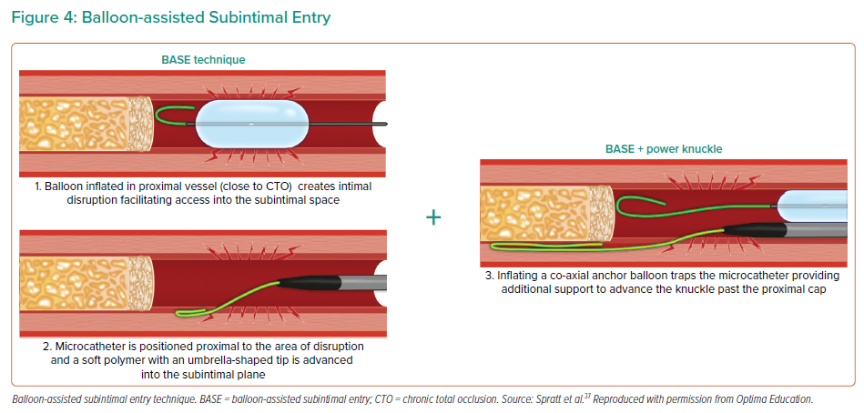 Impact Of Calcium In Chronic Total Occlusion (CTO) Treatment