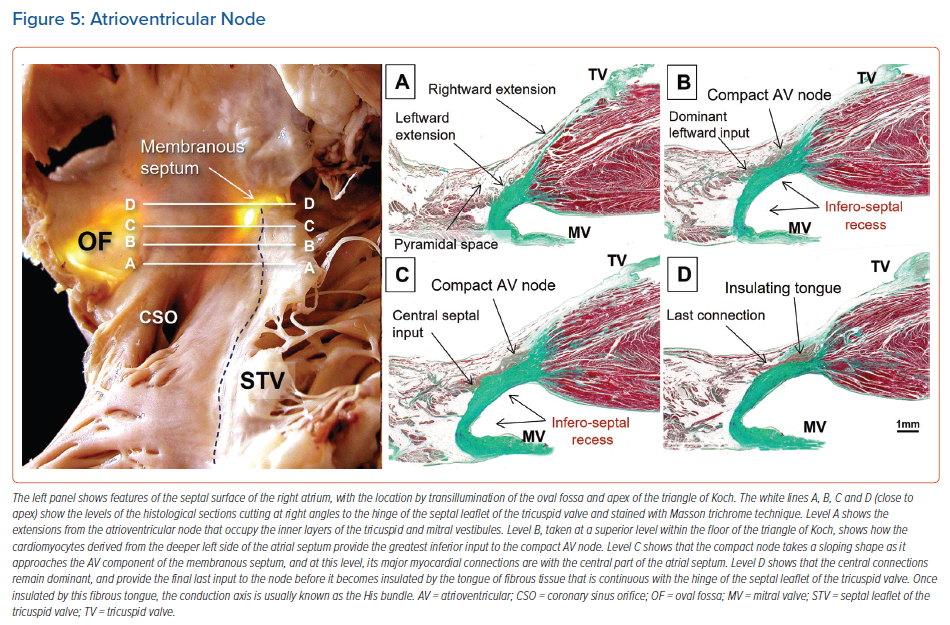 Atrioventricular Node | Radcliffe Cardiology