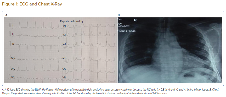 ECG And Chest X-Ray | Radcliffe Cardiology