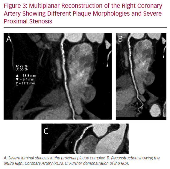 Multiplanar Reconstruction Of The Right Coronary Artery Showing ...