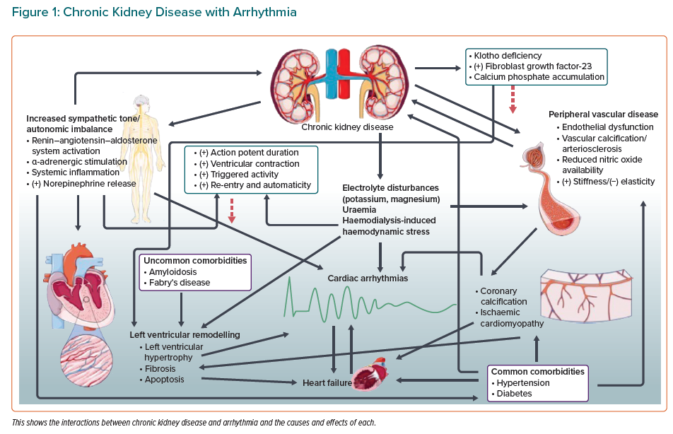 Chronic Kidney Disease With Arrhythmia | Radcliffe Cardiology