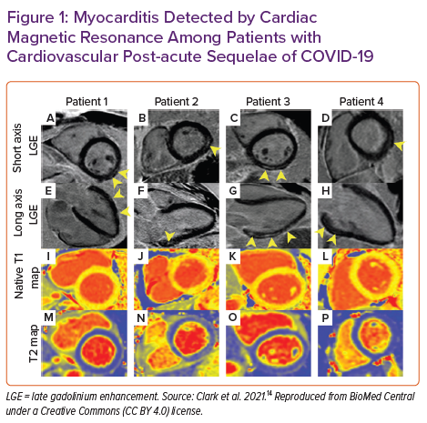 Myocarditis Detected By CMR Among Patients With Cardiovascular Post ...