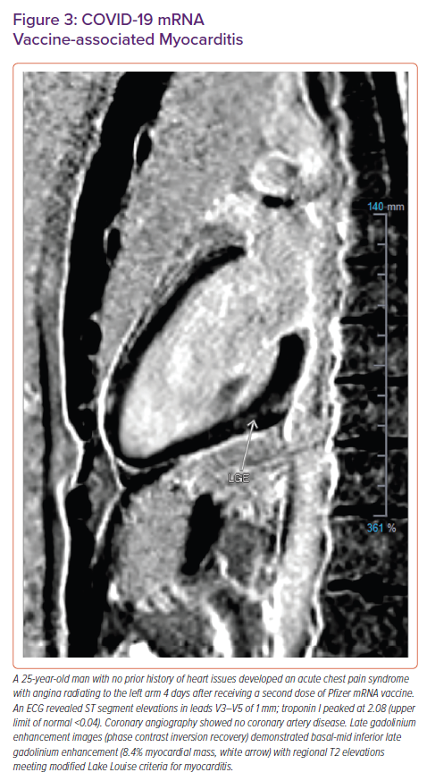 COVID-19 MRNA Vaccine-associated Myocarditis | Cardiac Complications ...