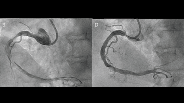 Mechanical Thrombosuction in Ectatic Coronary Artery with Large Thrombus