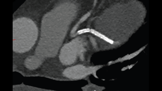 Coronary CT Angiography in Acute Coronary Syndrome