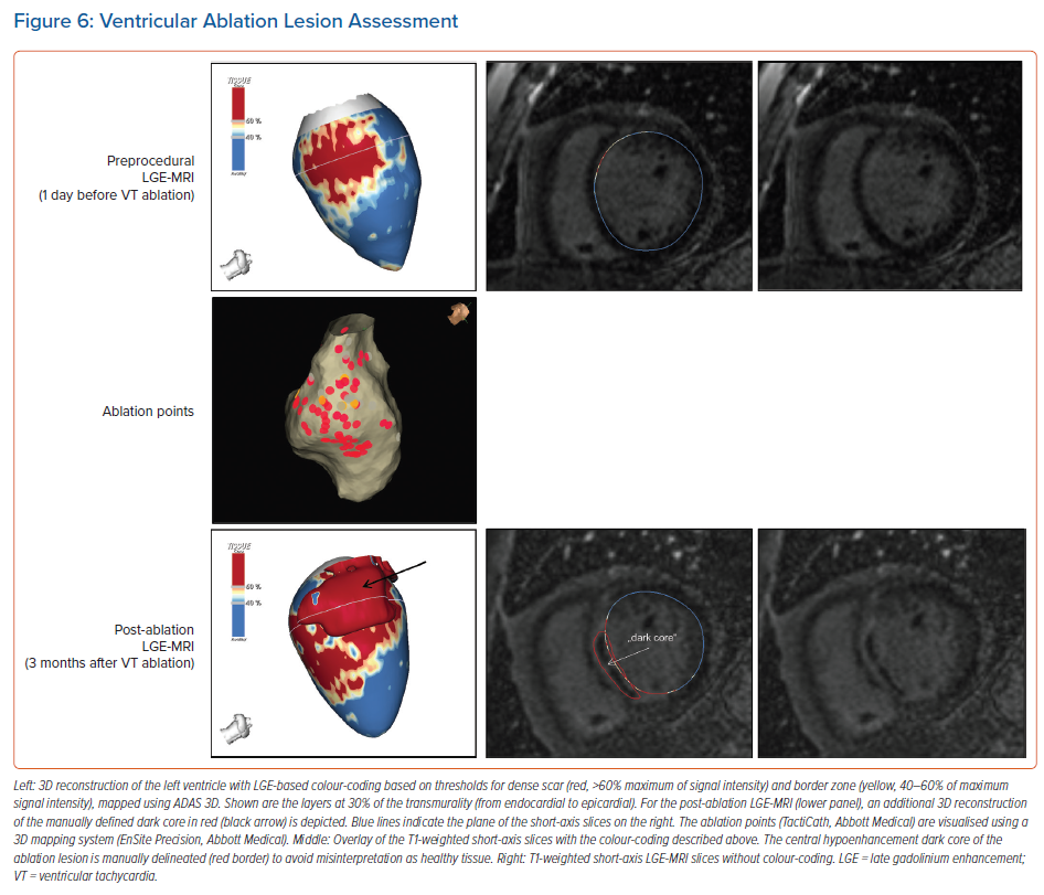 Ventricular Ablation Lesion Assessment | Radcliffe Cardiology