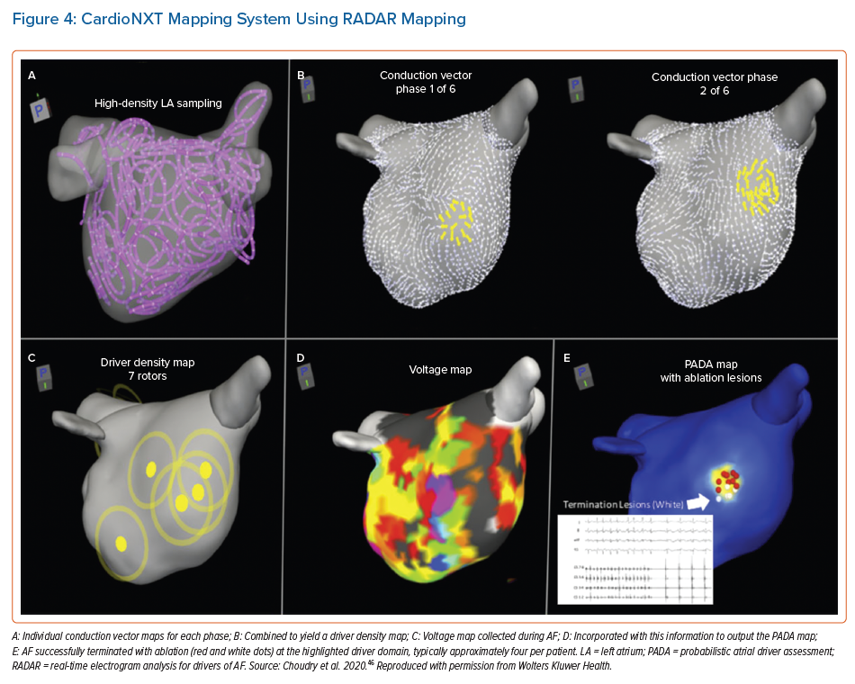 Future Directions For Mapping Atrial Fibrillation | AER Journal