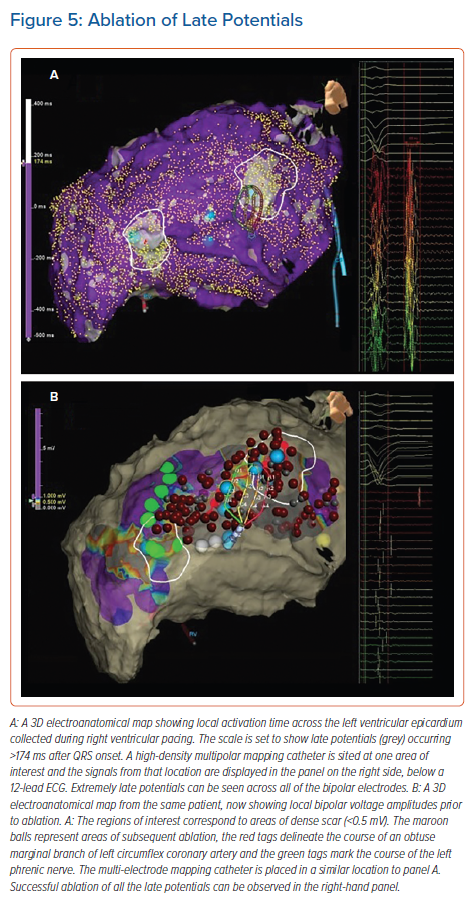 Ablation Of Late Potentials | Ventricular Arrhythmia | Radcliffe Cardiology