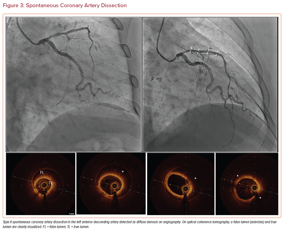 Spontaneous Coronary Artery Dissection | Radcliffe Cardiology