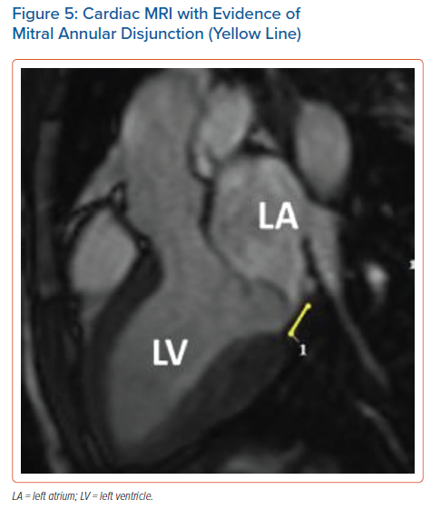 Cardiac MRI With Evidence Of Mitral Annular Disjunction (Yellow Line ...