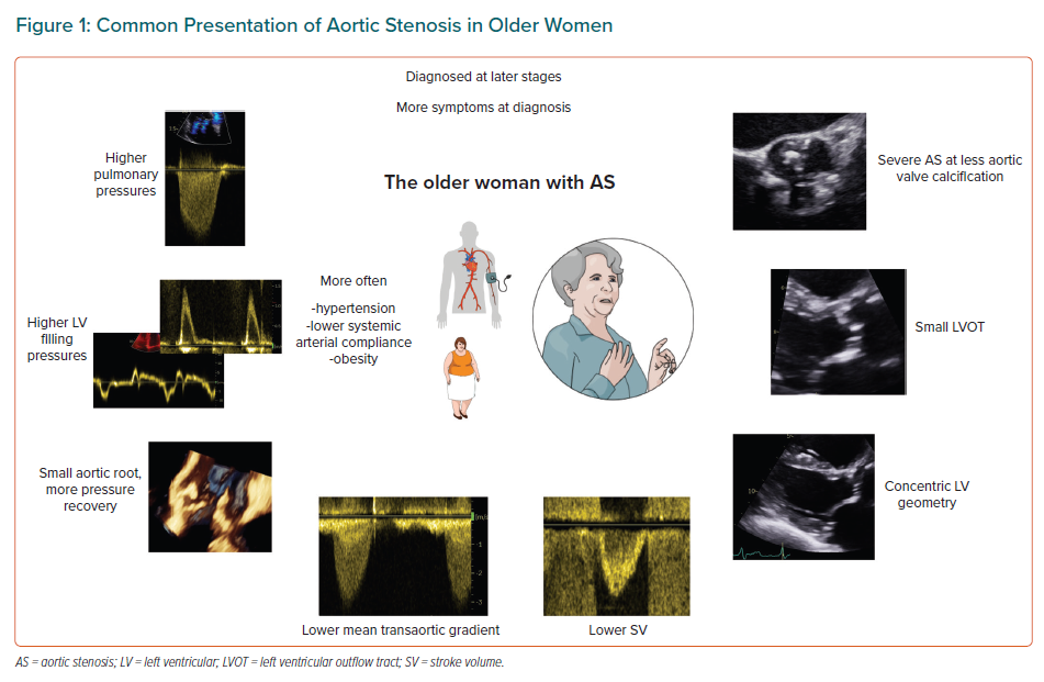 Common Presentation Of Aortic Stenosis In Older Women | Radcliffe ...