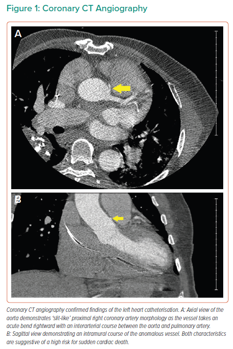 Coronary CT Angiography | Radcliffe Cardiology