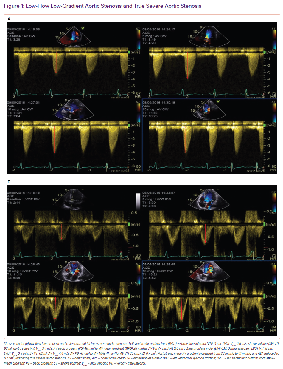 Low Flow Low Gradient Aortic Stenosis And True Severe Aortic Stenosis   Figure1 Low Flow Low Gradient 