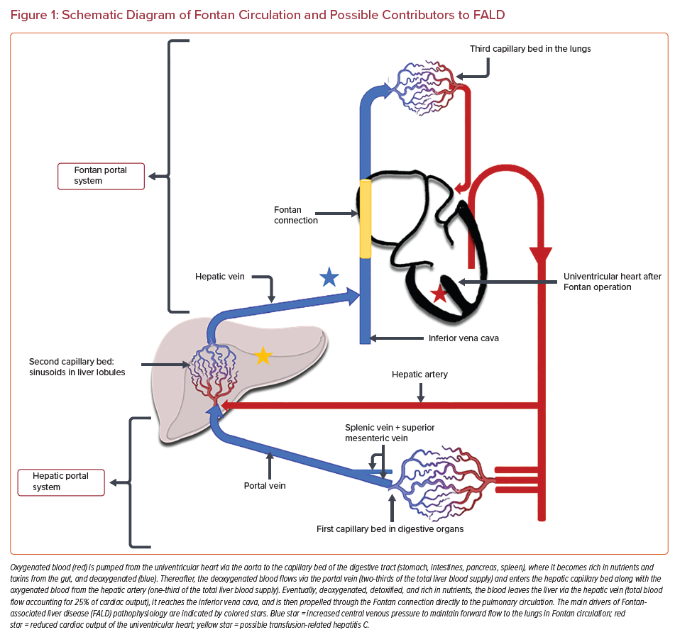 Fontan-associated Liver Disease: A Practical Review | USC Journal