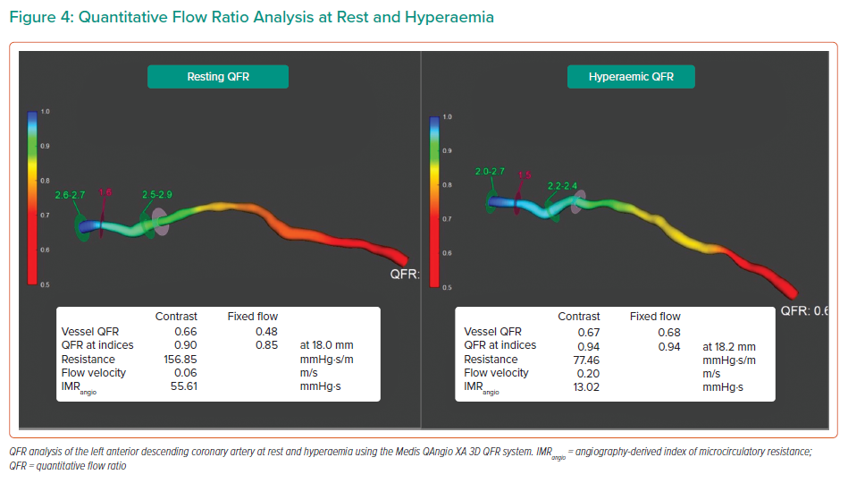 Quantitative Flow Ratio Analysis At Rest And Hyperaemia | Radcliffe ...