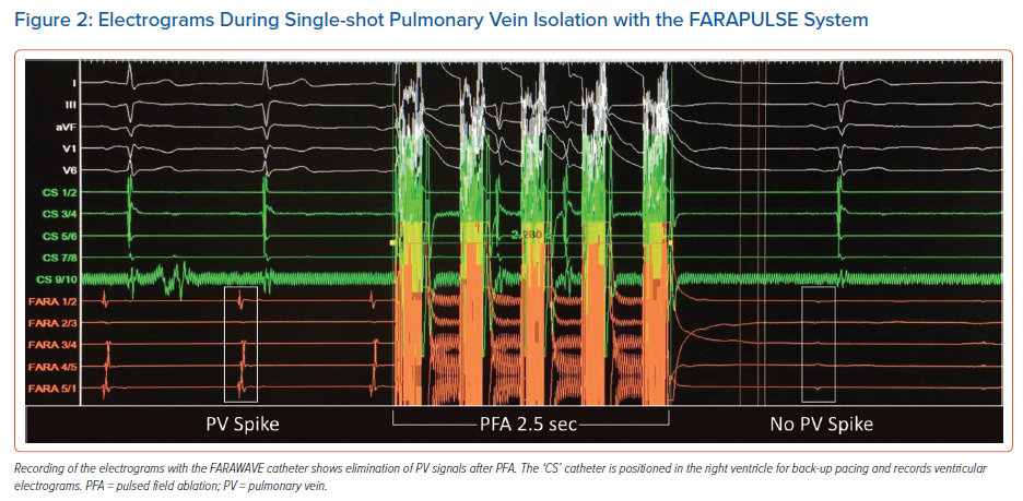 Pulsed Field Ablation For Atrial Fibrillation | AER Journal