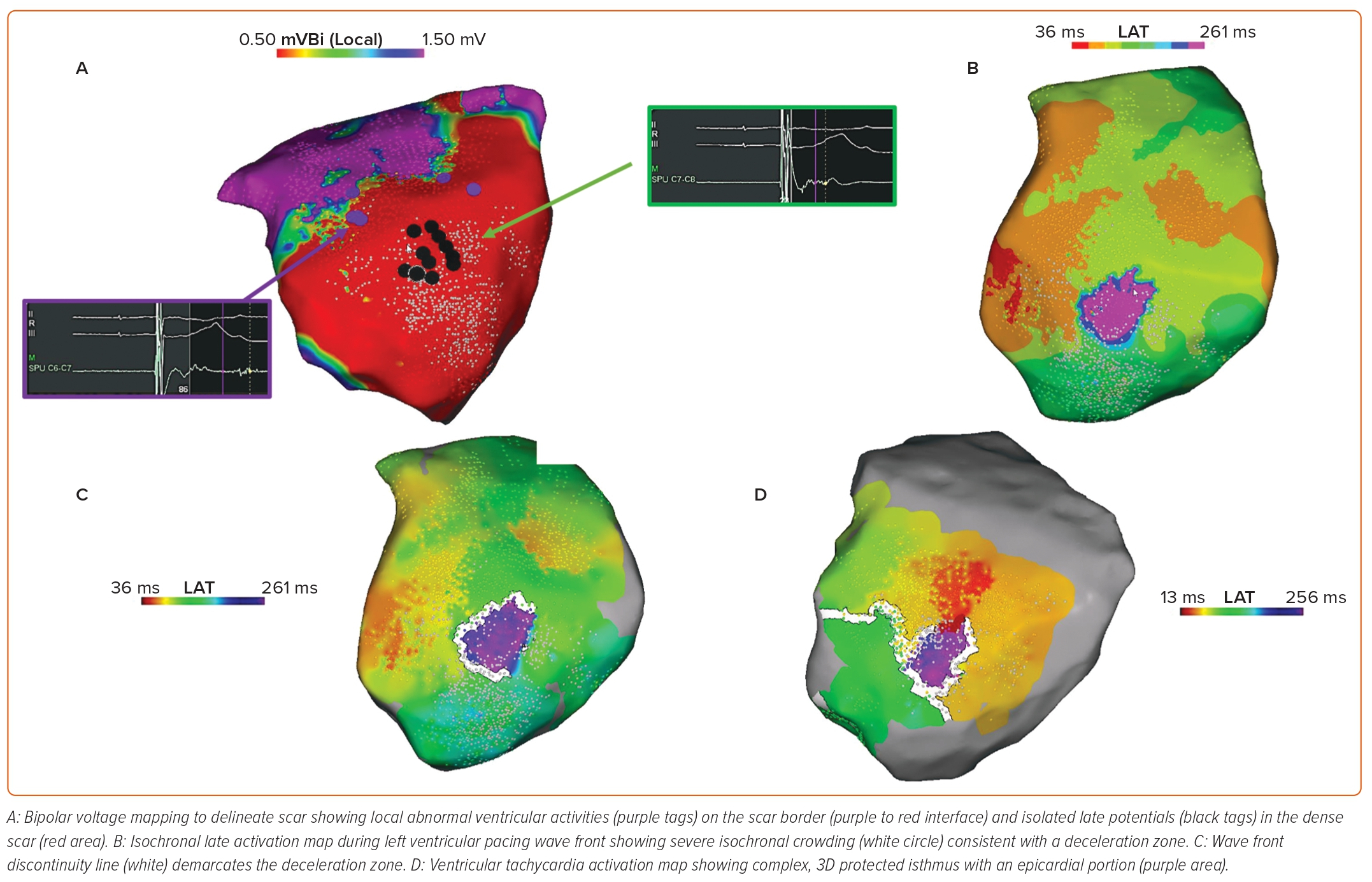 Figure 4: Substrate Ablation And Ventricular Tachycardia Activation ...