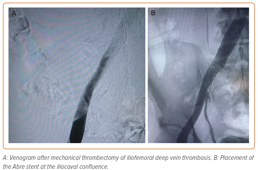 Figure 3: Abre Placement Following Thrombectomy Of Acute Iliofemoral ...