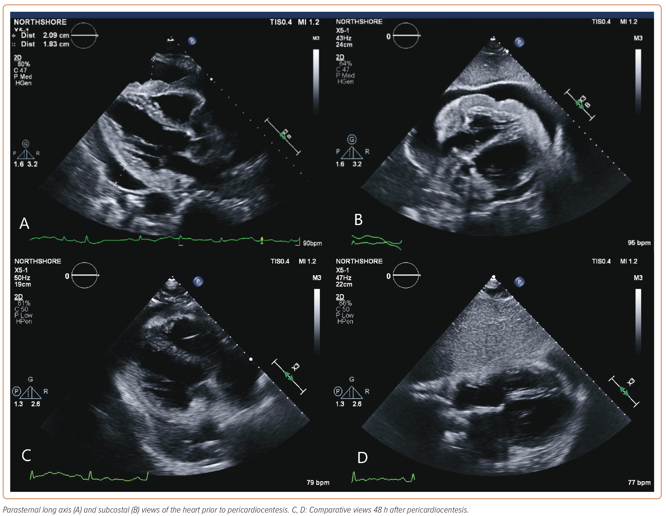 A Case Of Primary Cardiac B-cell Lymphoma Diagnosed With Cardiac MRI ...