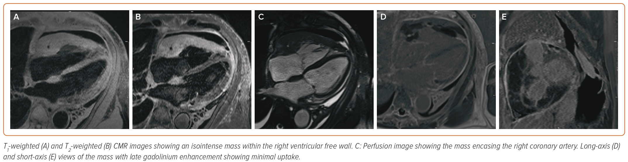 Figure 3: Cardiac MRI Of The Cardiac Mass | Radcliffe Cardiology