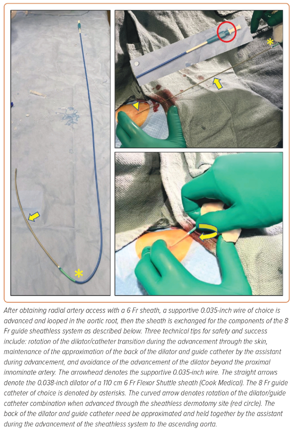 Figure 2: 8 Fr Sheathless Radial Technique | Radcliffe Cardiology