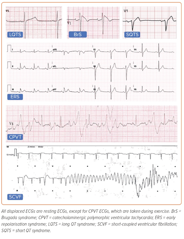 Figure 1: Characteristic ECG Findings of Inherited Primary Arrhythmia ...