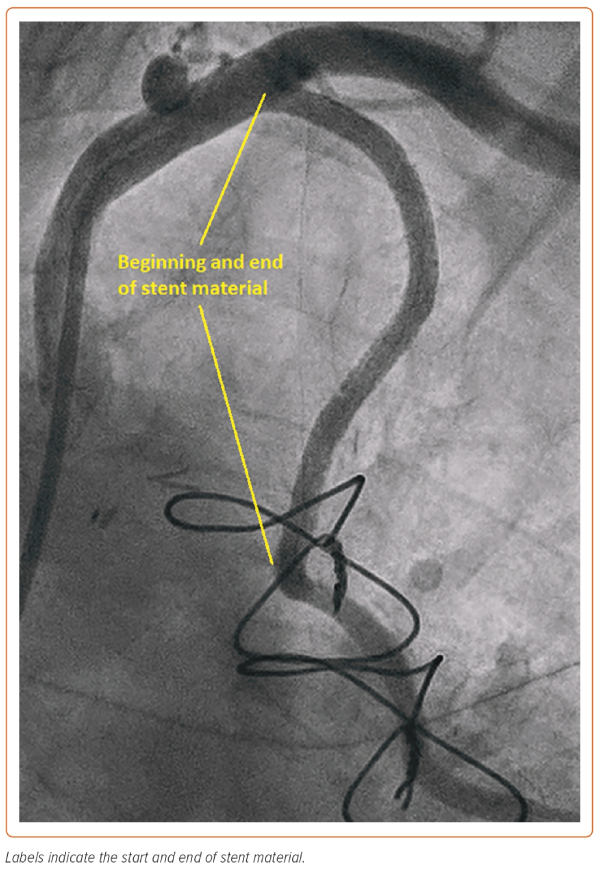 Figure 3: Left Internal Mammary Artery Appearance After Entire ...