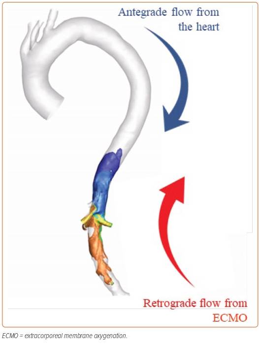 Figure 1: Veno-arterial Extracorporeal Membrane Oxygenation Increases ...