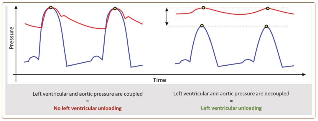 Automatic Left Ventricular Unloading Using A Percutaneous Transvalvular ...