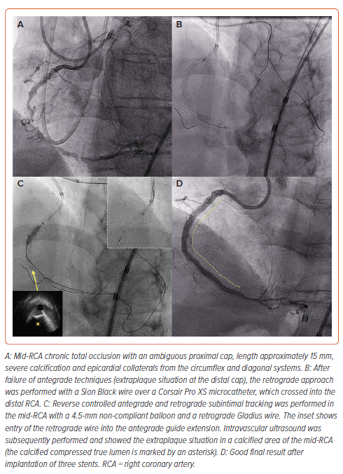 Figure 3: Guide Catheter Extensionfacilitated Reverse Controlled ...