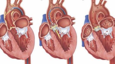 Managing Stroke During Transcatheter Aortic Valve Replacement