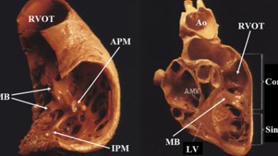 Anatomical Consideration in Idiopathic Ventricular Arrhythmia Ablation