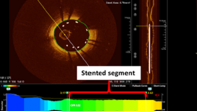 Overview of Quantitative Flow Ratio and Optical Flow Ratio in the Assessment of Intermediate Coronary Lesions
