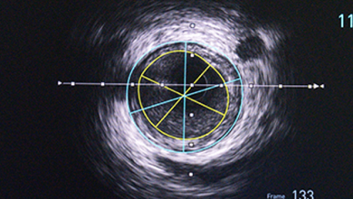 Role of Intravascular Ultrasound in Guiding Complex Percutaneous Coronary Interventions
