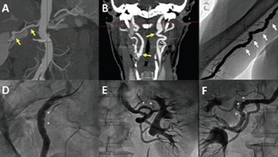 Spontaneous Coronary Artery Dissection: Mechanisms, Diagnosis and Management