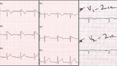 Current Controversies and Challenges in Brugada Syndrome