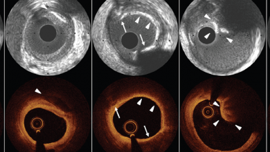 The Value of Intracoronary Imaging and Coronary Physiology When Treating Calcified Lesions